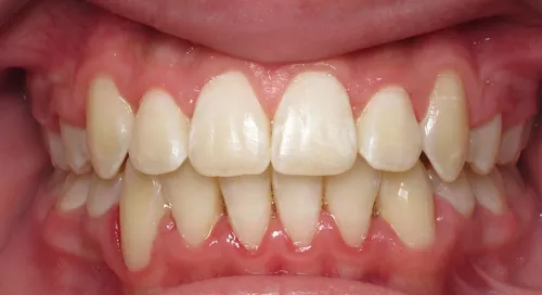 After - Patient smile transformation